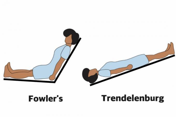 Fowler's i Trendelenburg